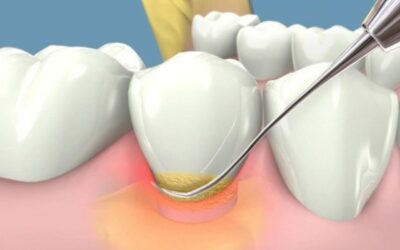 Enfermedades de las encías o Enfermedad periodontal